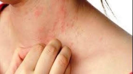 حمو النيل لدى الأطفال.. 7 طرق للتخلص والوقاية منه – القاهرة تايمز